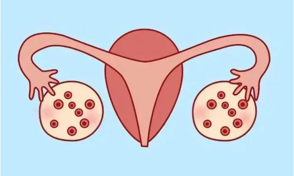 多囊卵巢可以自然受孕吗？用什么方法比较好呢？